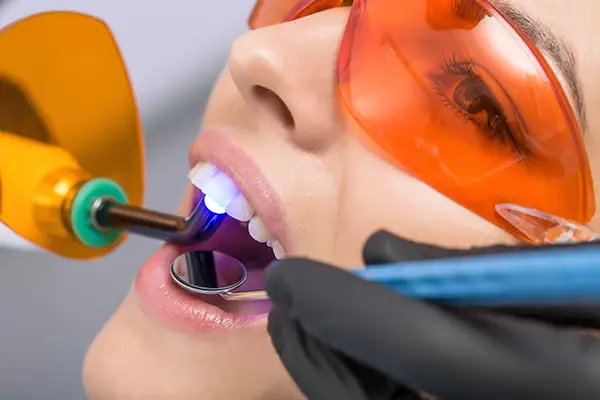 A dentist applying a curing light during a dental bonding procedure while the patient wears protective orange glasses. A dentist applying a curing light during a dental bonding procedure while the patient wears protective orange glasses.