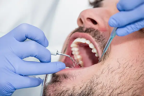 Dentist performing a periodontal cleaning procedure on a male patient using dental tools to remove plaque. Dentist performing a periodontal cleaning procedure on a male patient using dental tools to remove plaque.