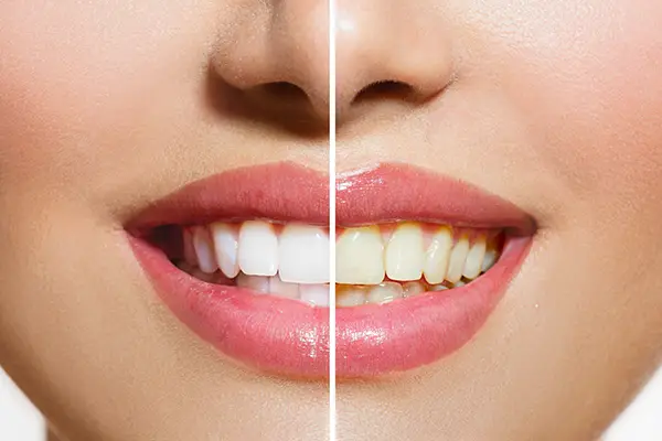 A woman's smile, before and after her professional teeth whitening treatment. A woman's smile, before and after her professional teeth whitening treatment.